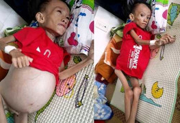 Xót thương bé trai 6 tuổi bụng to như trống đau đớn vật vã từng đêm