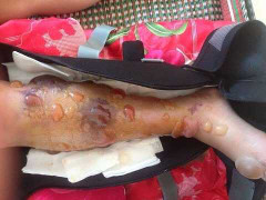 Nữ sinh bị cưa chân thương tâm: Kíp trực có bị xử lý hình sự?