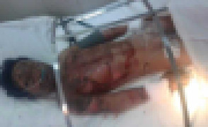 Nướng sắn bằng xăng, bé trai bỏng nặng toàn thân