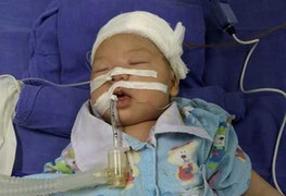 Dao quắm đâm xuyên sọ não trẻ 35 ngày tuổi