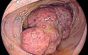 Ung thư đại tràng: Căn bệnh 'giết người' hàng đầu sẽ tăng nhanh