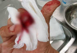 Nhà báo Đỗ Doãn Hoàng bị 3 kẻ lạ mặt đánh dập ngón tay