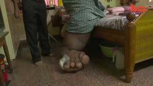 Kinh ngạc người có bàn chân nặng 100kg