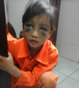 Bé gái bị cô giáo đánh bầm dập vì viết bài chậm