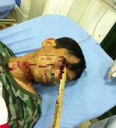 Ngã xe máy, người đàn ông bị cọc nhọn đâm xuyên mắt