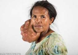 Người phụ nữ cắt bỏ khối u to như đầu người trên mặt