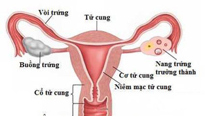 Uống thuốc ngừa thai khẩn cấp có thể vô sinh, ung thư