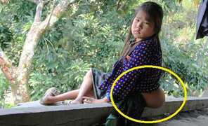 Video: Cô bé 'người vượn' cõng trên mình khối u quái dị