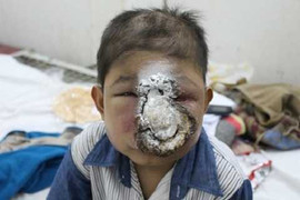 Ung thư 'ăn' mũi bé trai