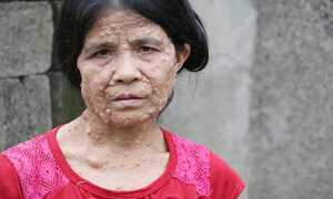 Người đàn bà xứ Nghệ bị nổi u cục toàn thân