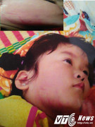 Phụ huynh tố cô giáo mầm non đánh bé gái 4 tuổi bầm mặt