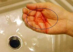 Không để ý 3 dấu hiệu đầu tiên trong ngày, coi chừng ung thư