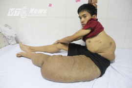 Nghiệt ngã cảnh đời thanh niên mang ‘chân voi’ hơn 22 năm