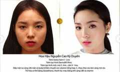 Thẩm mỹ viện chứng minh Hoa hậu Kỳ Duyên nói dối