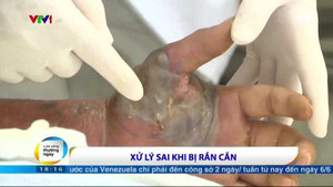 Clip: Hướng dẫn sơ cứu đúng cách khi bị rắn cắn