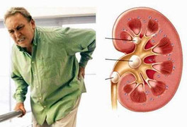 Đề phòng các dấu hiệu sỏi thận dễ nhầm sang bệnh lý khác