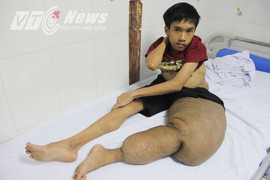Vì sao nam thanh niên mang 'chân voi' khổng lồ chưa thể phẫu thuật?