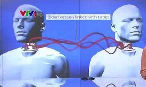 Video: Thực hiện ca ghép đầu đầu tiên trên thế giới cho bệnh nhân Trung Quốc