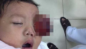 Nỗi ám ảnh ung thư võng mạc 'ăn' mắt, não trẻ nhỏ