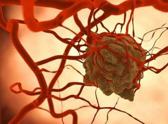 Bất ngờ trước cách loại bỏ tế bào ung thư ai cũng làm được