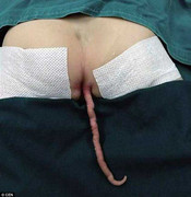 Sốc với hình ảnh cậu bé mọc đuôi 15cm sau lưng