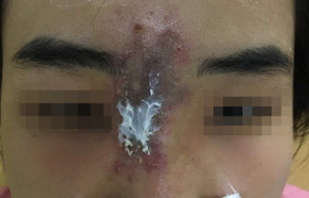 Tiêm filler nâng mũi, thiếu nữ TP.HCM bị méo mặt, hoại tử da