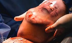 Em bé sinh ra trong túi ối còn nguyên vẹn dù sinh mổ