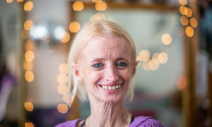 Người phụ nữ 41 tuổi nặng 26kg và trông như bà lão