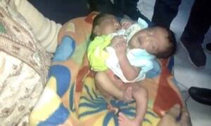 Cặp song sinh cùng chung thân thể hiếm gặp