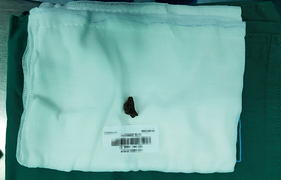 Gắp mảnh đạn găm trong lưng người đàn ông suốt 40 năm