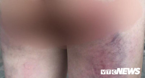 Cô giáo bị tố đánh học sinh lớp 4 bầm tím do không làm được bài