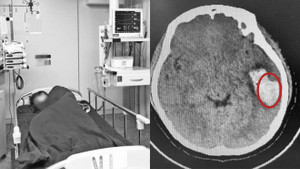 Nữ sinh vỡ mạch máu não khi hát karaoke