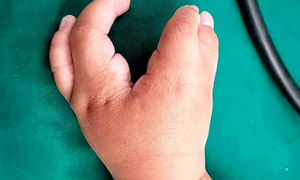 Phẫu thuật cứu cậu bé 2 tuổi có tay chân dị tật như 'càng tôm hùm'