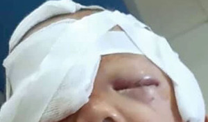 Bé 20 tháng tuổi bị chó nhà cắn rách mặt