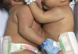 Phẫu thuật tách hai bé gái song sinh dính nhau ở gan