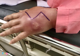 Tiêm chất làm đầy không rõ nguồn gốc ở spa, hai phụ nữ bị mù mắt