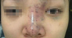 Chủ spa biến mất sau ca nâng mũi khiến nữ sinh TP.HCM mù mắt