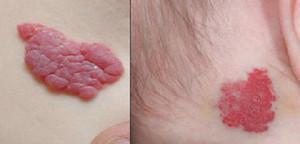 Thấy vết bớt đỏ tưởng nốt ruồi son, mẹ ngã ngửa khi biết đó là trọng bệnh