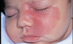 Những điều mẹ bầu cần ghi nhớ để con sinh ra không bị vết chàm xấu xí