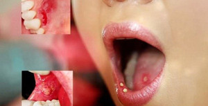 Cảnh báo: Vết lở loét nhỏ trong miệng có thể là dấu hiệu của bệnh ung thư 'chết người'