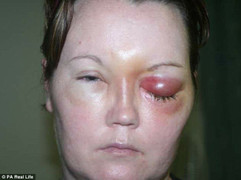 Cẩn thận bị loét giác mạc, mù mắt chỉ vì đeo kính áp tròng