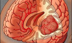 Nếu biết sớm điều này, u não sẽ không hoàn toàn là căn bệnh tử thần