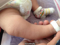 Mẹ mua giày lớn hơn 1 size để con đi được lâu, nào ngờ suýt hại con gãy xương chân