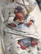 Kỳ diệu em bé sống sót khi sinh non ở tuần 22, làn da trong suốt nhìn thấy cả nội tạng