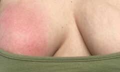 Xót xa nhìn bầu ngực sưng tím chứa đầy dịch của người mẹ khi cho con bú