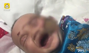 Ngã vào bếp lò dùng để sưởi ấm, bé gái bỏng cấp độ 3