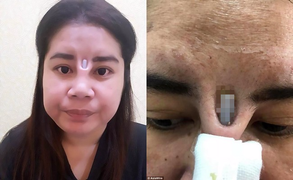 Rùng mình miếng silicon xuyên thủng da sau khi phẫu thuật nâng mũi