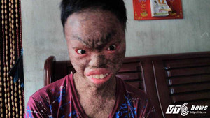 Nghẹn ngào tấm lòng của người mẹ có con trai là 'người vảy cá'