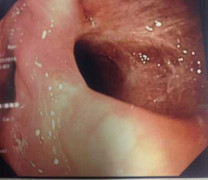 Bé gái thủng thực quản suốt 2 năm do nuốt đồ chơi