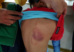 Tạm đình chỉ nữ giáo viên tiểu học đánh học sinh bầm tím lưng